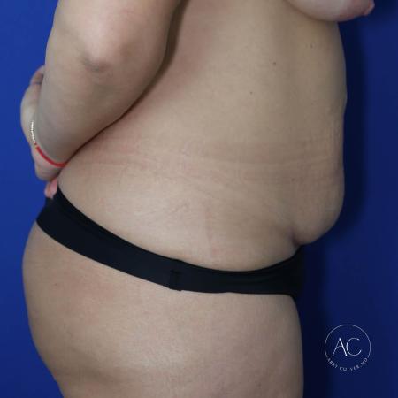 Before image 3 Case #130596 - Circumferential trunk liposuction, abdominoplasty