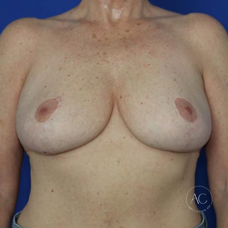 After image 1 Case #130566 - Breast reduction