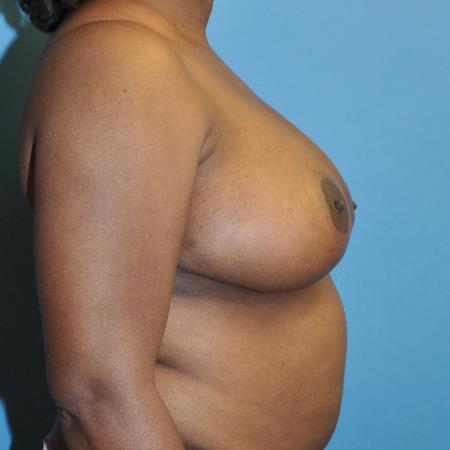 After image 3 Case #130291 - Breast Reduction