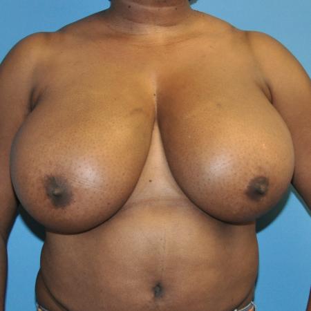 Before image 1 Case #130291 - Breast Reduction
