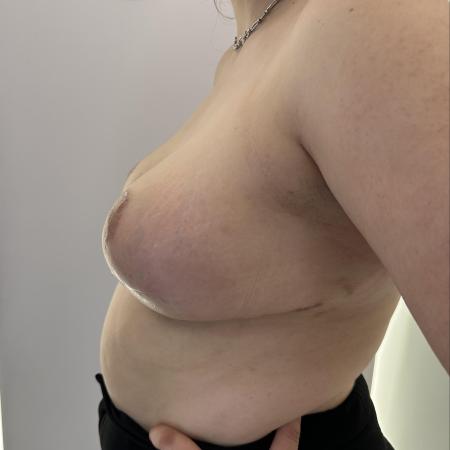 After image 2 Case #130481 - Breast Reduction