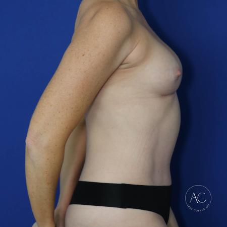 After image 3 Case #130611 - Breast aug w/ fat transfer and implants, aplasty