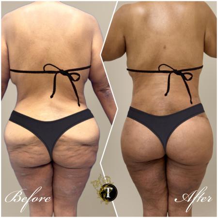 After image 1 Case #130451 - Tummy tuck and Lower body lift and liposuction