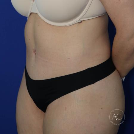 After image 2 Case #130596 - Circumferential trunk liposuction, abdominoplasty