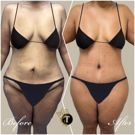 Before image 1 Case #130451 - Tummy tuck and Lower body lift and liposuction
