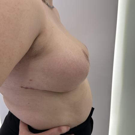 After image 3 Case #130481 - Breast Reduction