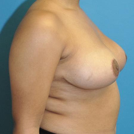 After image 3 Case #130266 - Breast Reduction
