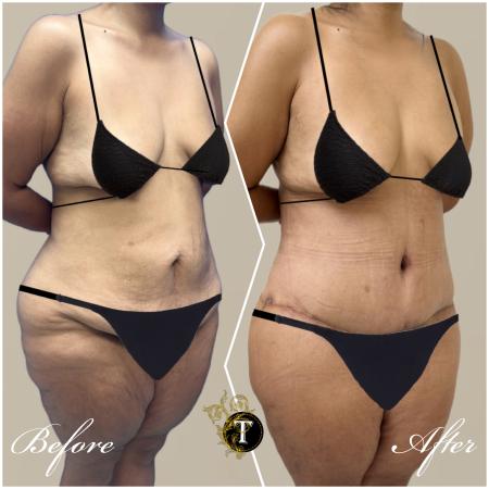 After image 2 Case #130451 - Tummy tuck and Lower body lift and liposuction
