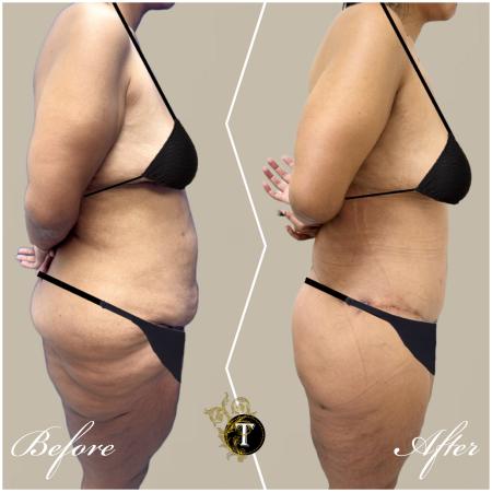After image 3 Case #130451 - Tummy tuck and Lower body lift and liposuction