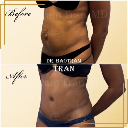 After image 2 Case #130461 - Tummy tuck
