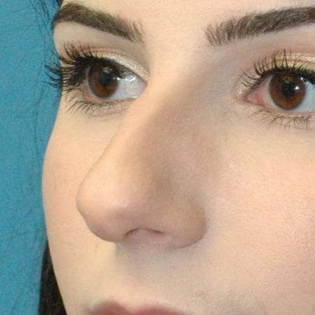 Before image 1 Case #130161 - Primary Rhinoplasty