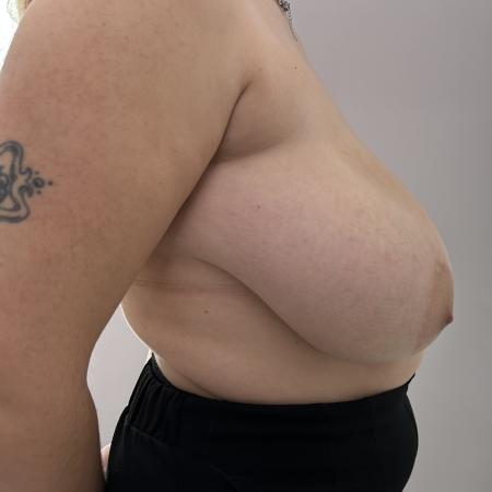 Before image 3 Case #130481 - Breast Reduction
