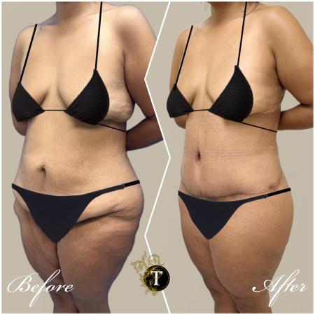 Before image 2 Case #130451 - Tummy tuck and Lower body lift and liposuction