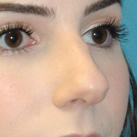 Before image 3 Case #130161 - Primary Rhinoplasty
