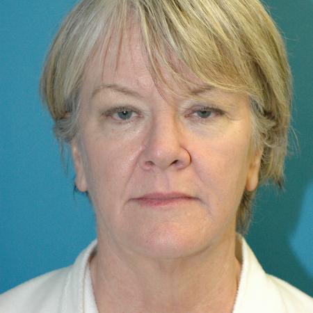 Before image 1 Case #130336 - Face and Necklift