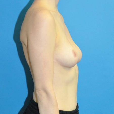 After image 3 Case #130271 - Breast Reduction