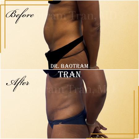 Before image 3 Case #130461 - Tummy tuck
