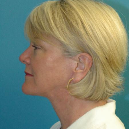 After image 3 Case #130336 - Face and Necklift
