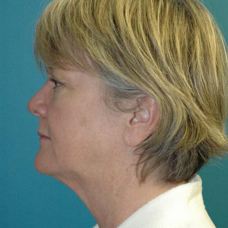 Before image 3 Case #130336 - Face and Necklift