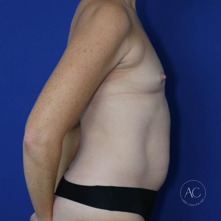 Before image 3 Case #130611 - Breast aug w/ fat transfer and implants, aplasty