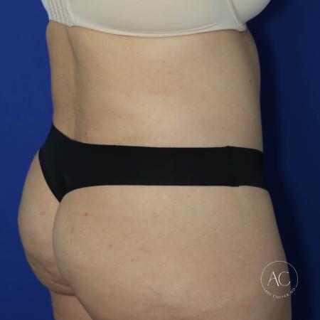 After image 4 Case #130596 - Circumferential trunk liposuction, abdominoplasty
