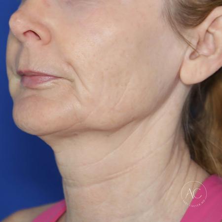 Before image 2 Case #130666 - Face and neck lift