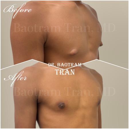 After image 2 Case #130516 - Gynecomastia Surgery