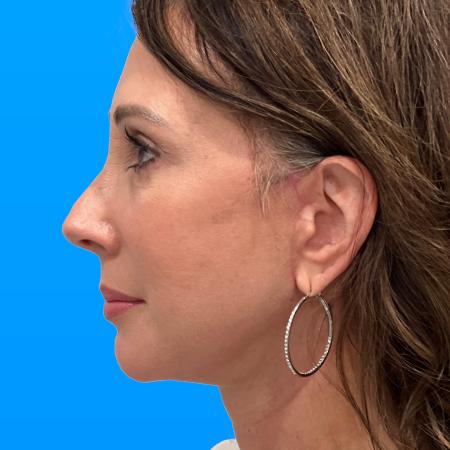 After image 3 Case #130221 - Facelift/Browlift/Lower Lid Blepharoplasty 