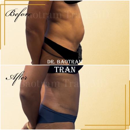After image 3 Case #130461 - Tummy tuck