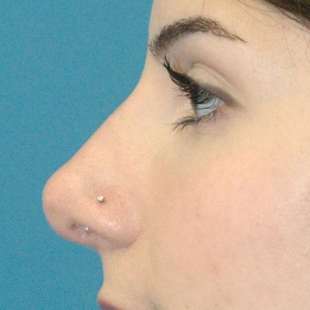 After image 2 Case #130161 - Primary Rhinoplasty