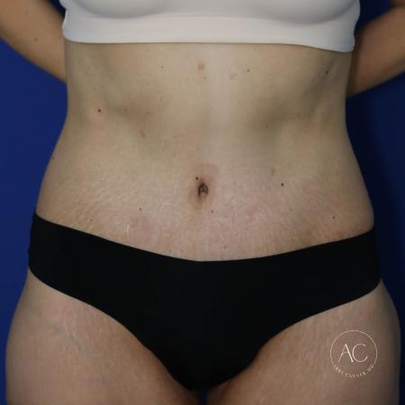 After image 1 Case #130651 - Extended abdominoplasty after weight loss