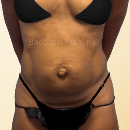 Before image 1 Case #130461 - Tummy tuck