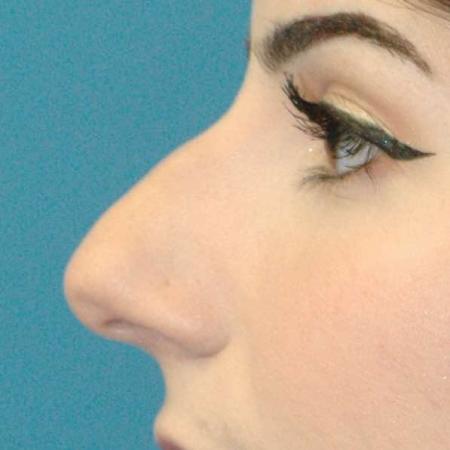 Before image 2 Case #130161 - Primary Rhinoplasty