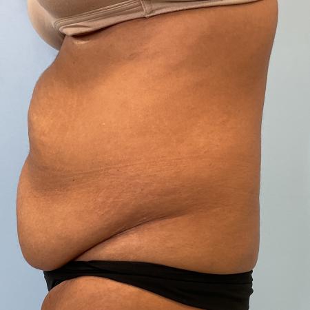 Before image 3 Case #131026 - 54 y.o. female with Tummy Tuck & Lipo of Flanks