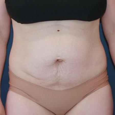 Before image 1 Case #130676 - Abdominoplasty