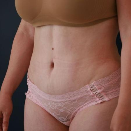 After image 2 Case #130676 - Abdominoplasty