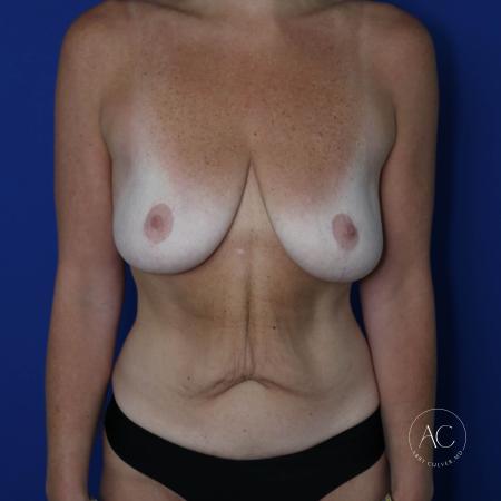 Before image 1 Case #132221 - Breast lift with implants and abdominoplasty