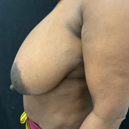 Before image 3 Case #133236 - Medial Pedicle Reduction Mammoplasty