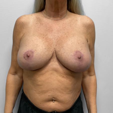 After image 1 Case #133116 - Breast Enhancement
