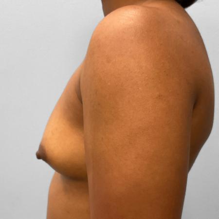 Before image 3 Case #132796 - Breast Augmentation