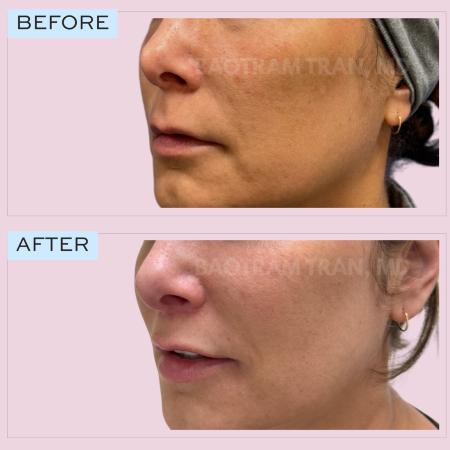 Before image 1 Case #132766 - Lip lift