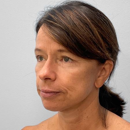 After image 2 Case #133111 - Facelift & Laser Resurfacing