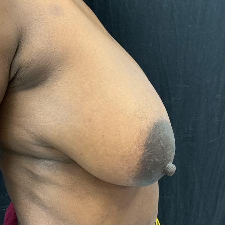Before image 2 Case #133236 - Medial Pedicle Reduction Mammoplasty