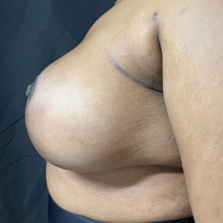 After image 2 Case #133231 - Medial Pedicle Reduction Mammoplasty