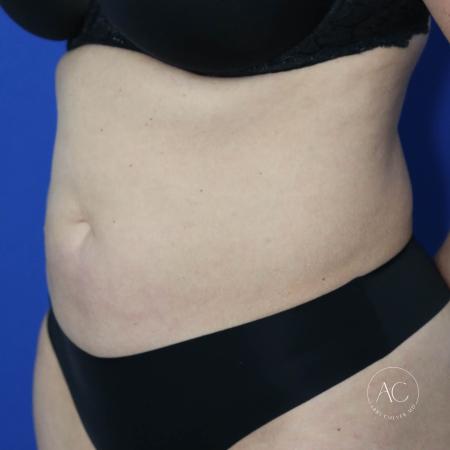 Before image 2 Case #132216 - Abdominoplasty with liposuction
