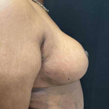 After image 2 Case #133251 - Medial Pedicle Reduction Mammoplasty
