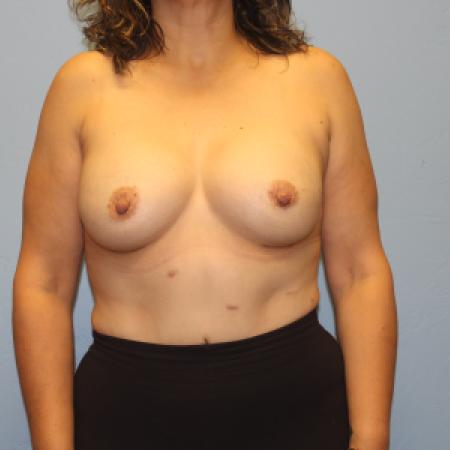 After image 1 Case #131716 - Breast Augmentation Rao Plastic Surgery Tucson, AZ