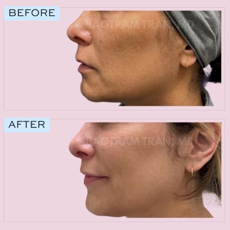 Before image 2 Case #132766 - Lip lift