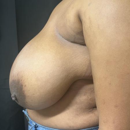 Before image 2 Case #133231 - Medial Pedicle Reduction Mammoplasty