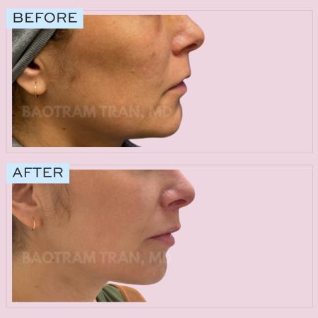 After image 2 Case #132766 - Lip lift